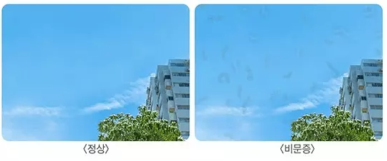 비문증과 파인애플 효과