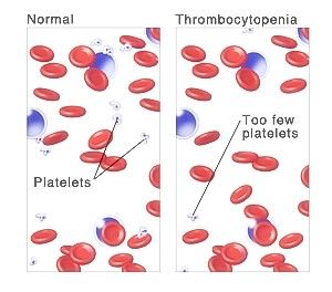 혈소판 수치가 낮으면