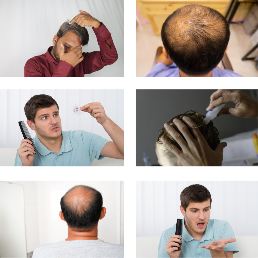 탈모의-초기-증상