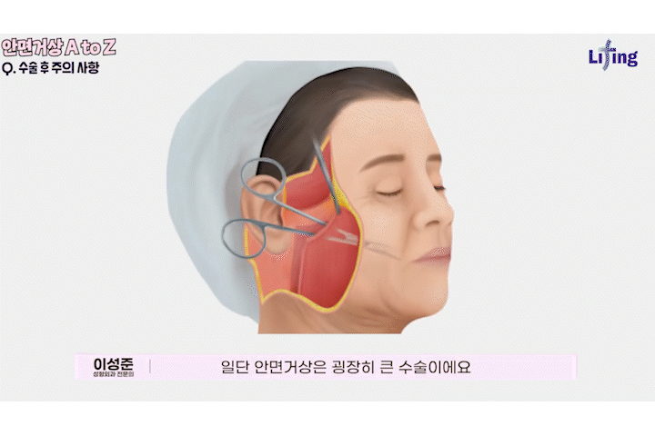 일산성형외과 안면거상후기