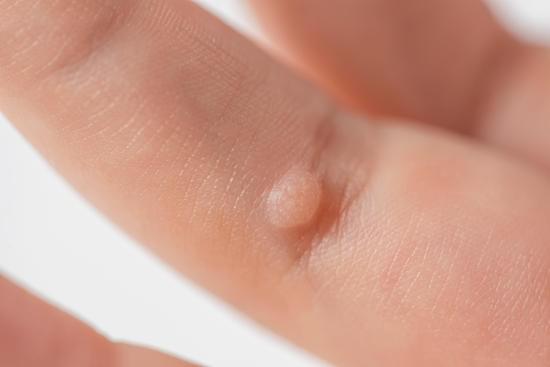 사마귀 (Wart) &ndash; 인유두종 바이러스(HPV) 감염