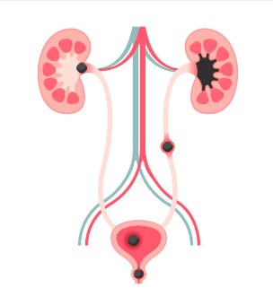 요로결석 증상과 진단 방법 총정리