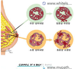 침윤성·비침윤성 유방암, 삼중 음성·HER2 양성
