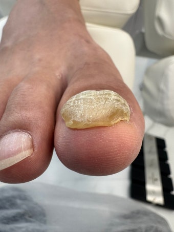 각화비대증과 발톱무좀: 원인&amp;#44; 증상&amp;#44; 예방법 한방에