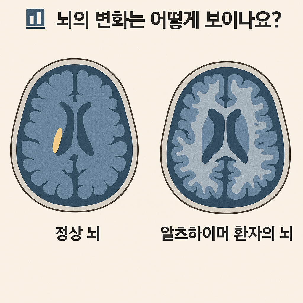 알츠하이머환자의 뇌변화