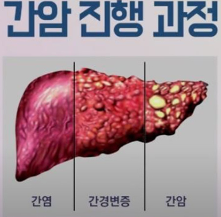 간암진행과정