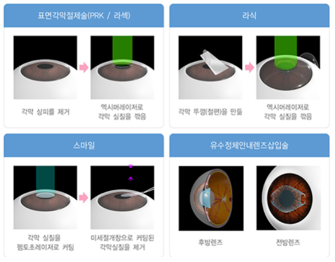 라식 라섹 수술 받은 사람도 백내장 수술 가능한지 알아보기