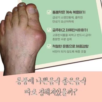 발가락 통풍 증상 및 대처방법_21