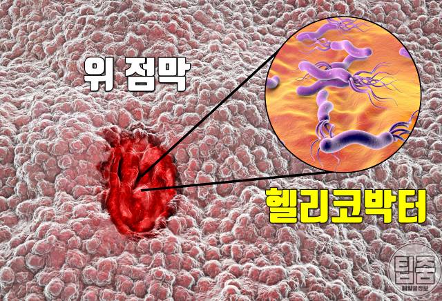 위염 증상 위염원인 위궤양 헬리코박터