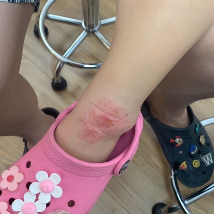 피부과 간지럼증 가려움증 치료방법