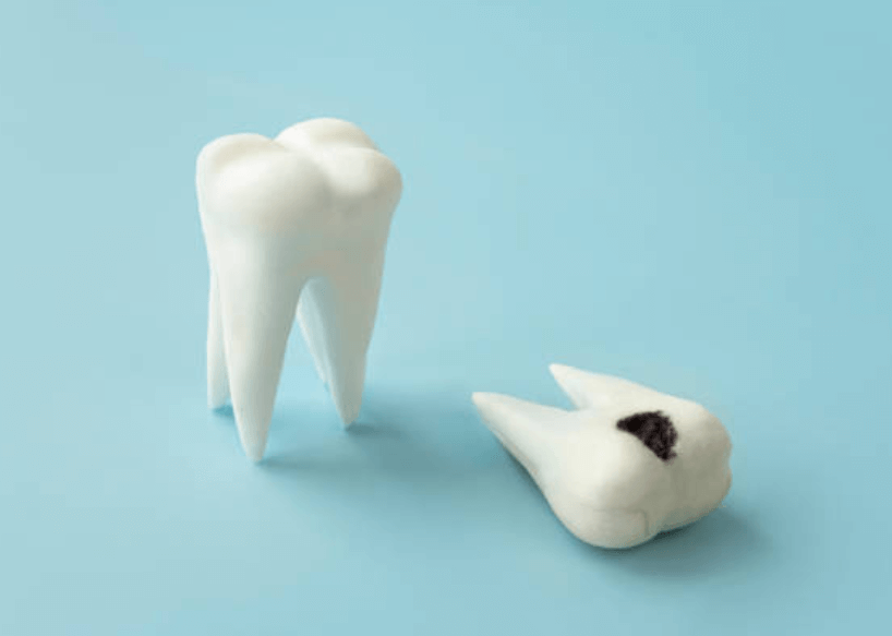 충치치료 실비보험