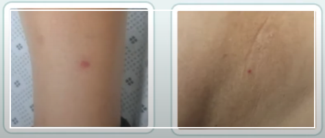 쯔쯔가무시 초기증상 치료방법 