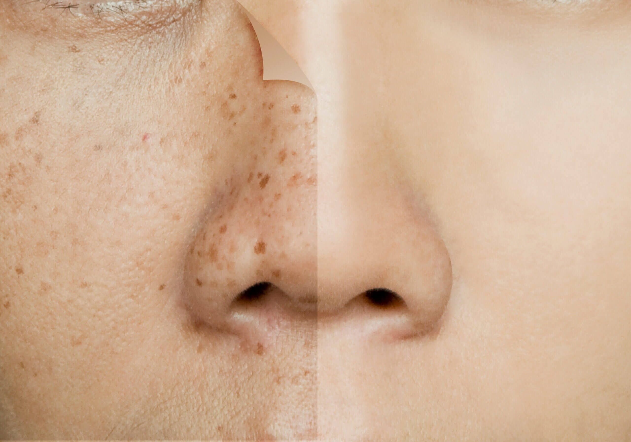 기미 잡티 주근깨 개선을 위한 비타민C와 나이아신아마이드 성분 정보 및 자외선 차단 중심의 피부 관리 방법을 안내하는 스킨케어 가이드 이미지