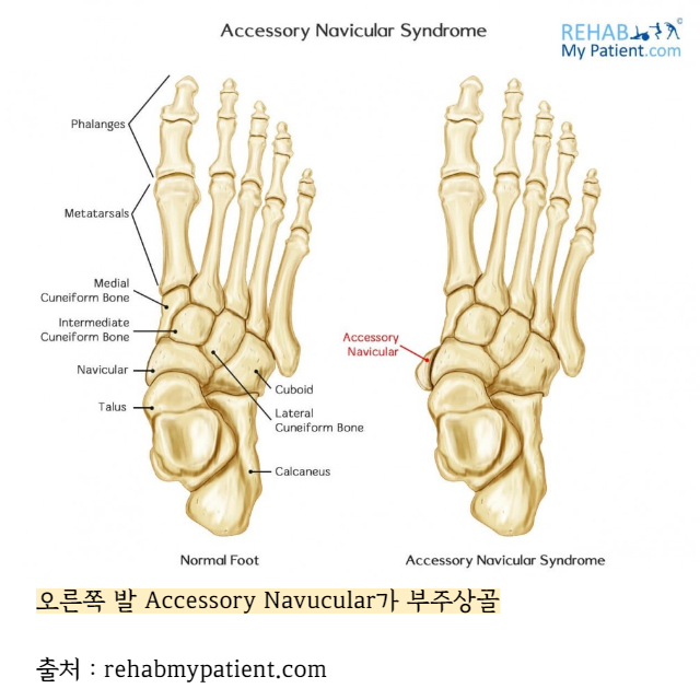 부주상골-증후군