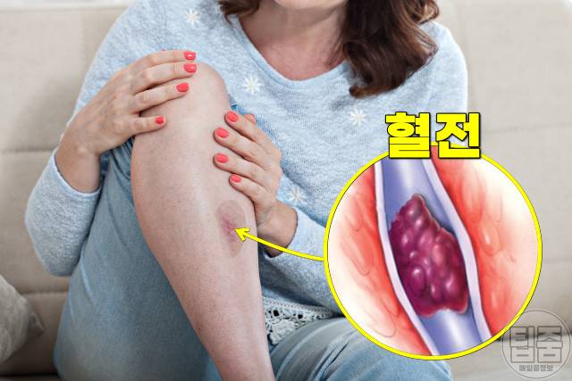 팔 다리 멍 자주 생기는 이유 멍원인 혈전증