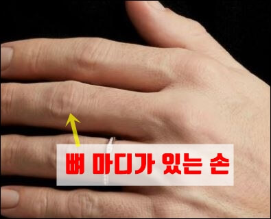 마디가 돌출된 손가락