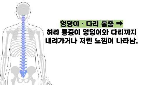 추간판 탈출증 증상