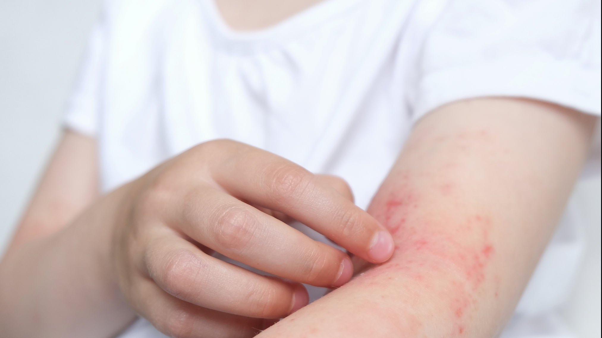 습진 생기는 이유