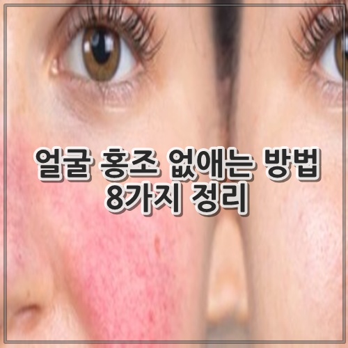 얼굴 홍조 없애는 방법 8가지