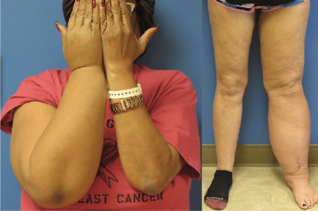 몸이 붓는 원인