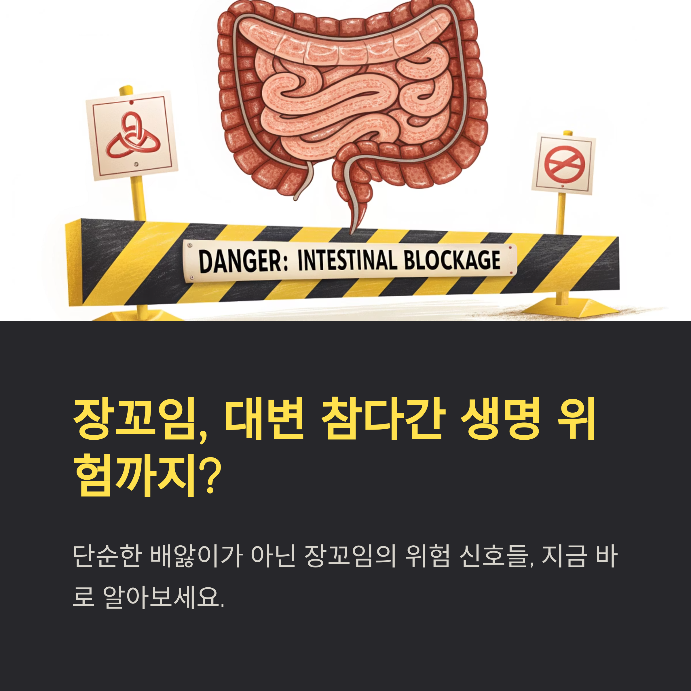 장꼬임