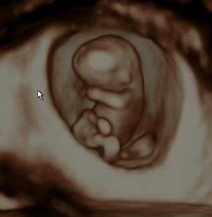 임신초기 입덧 토덧 입덧약