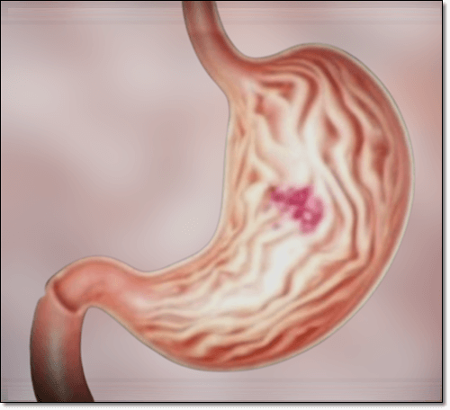 결장 암 이미지