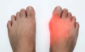 발가락 통풍 증상 및 대처방법_3