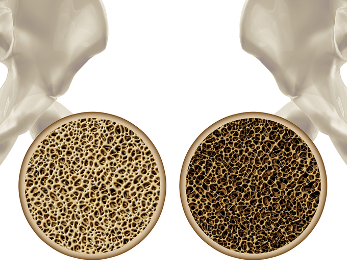 골다공증 뼈 단면