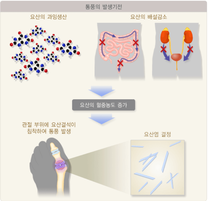 요산이 정상적으로 배출되지 않는 이미지
