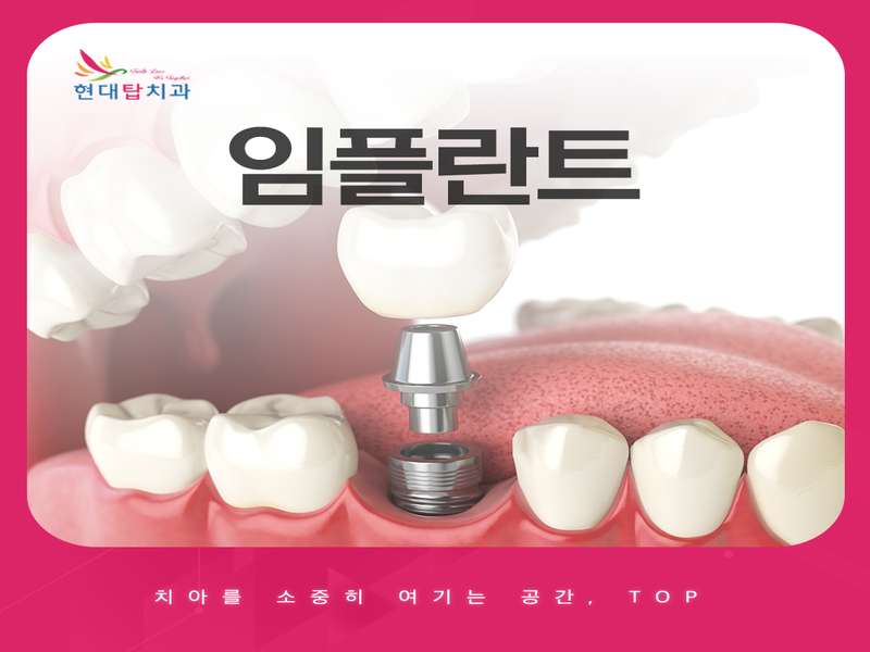 울산 동구 임플란트 치과 BEST4 | 가격비교 | 추천 | 후기 | 저렴한곳 | 전문 병원 | 총정리 - 3. 현대탑치과의원 소개 - 3.2 고객 피드백 3.2 고객 피드백