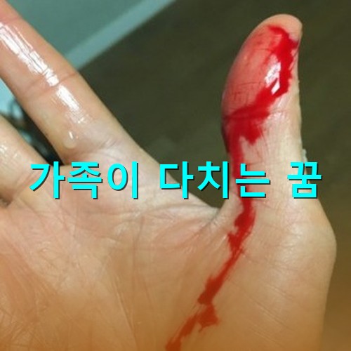 엄지-손가락을-베어-손에서-피가-철철나는-모습