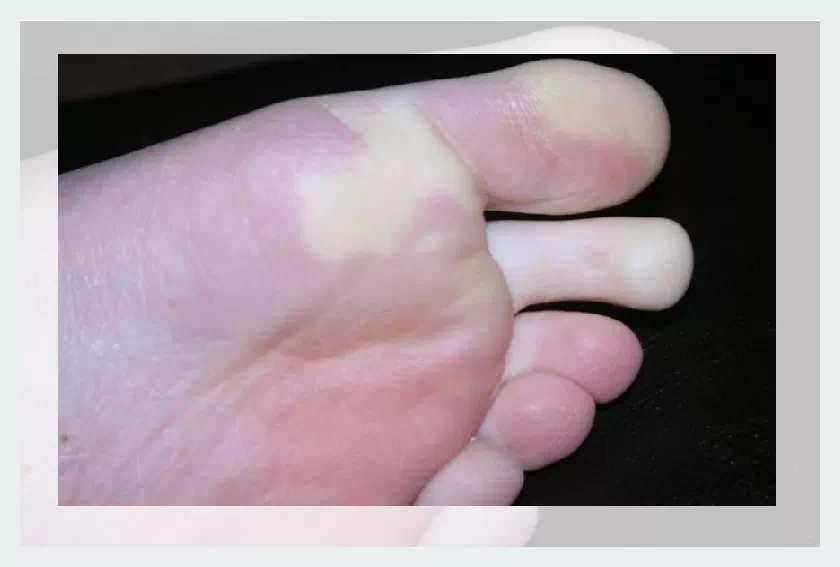 발 레이노이드증후군