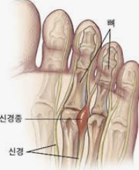 발바닥 통증부위