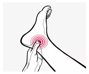 족저근막염 치료법