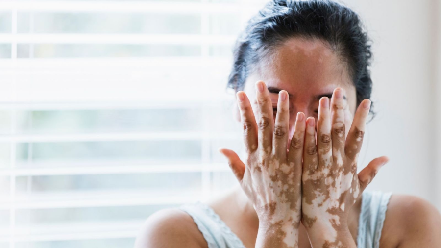 백반증 완벽 가이드