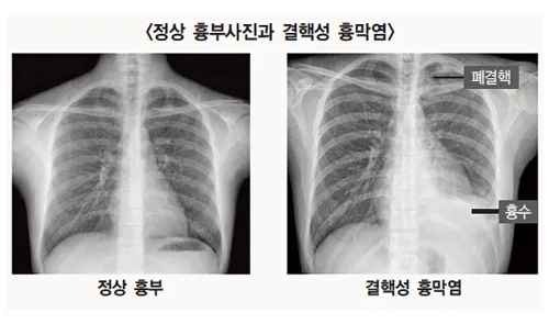 늑막에 물이 차는 이유와 치료 방법_2