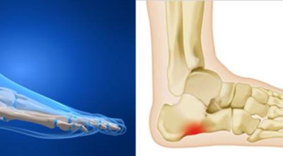 족저근막염 이미지
