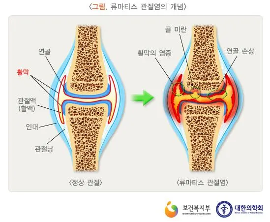 관절염에 좋은 음식 TOP 10_2