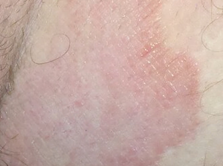 사타구니 가려움증