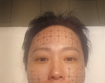 써마지 시술 전