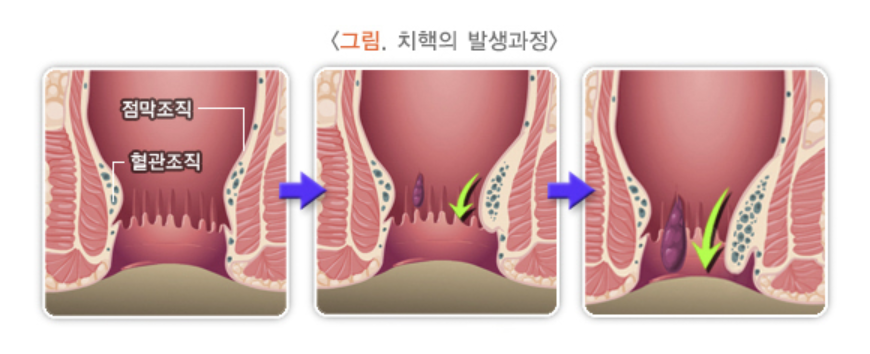 치핵의 발생과정