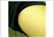 빈대 퇴치법과 효과적인 빈대 퇴치제