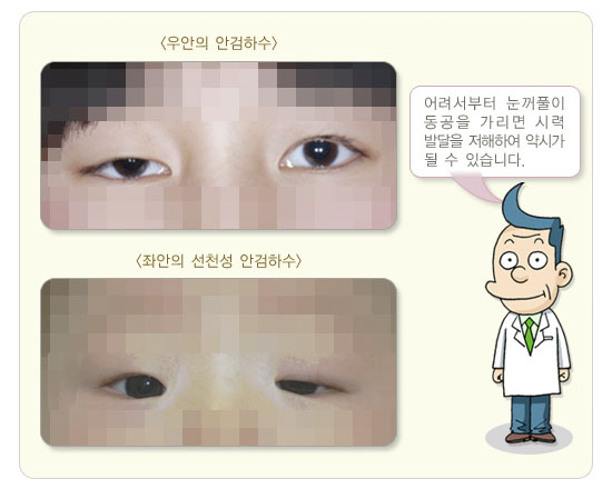 안검하수증상