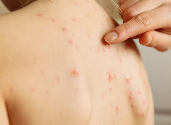 싱그릭스 대상포진