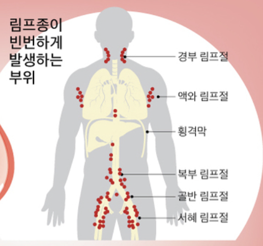 림프종 증상 10가지 총정리 섬네일