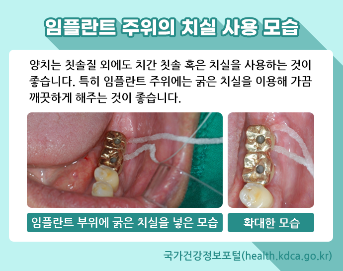 치실 사용