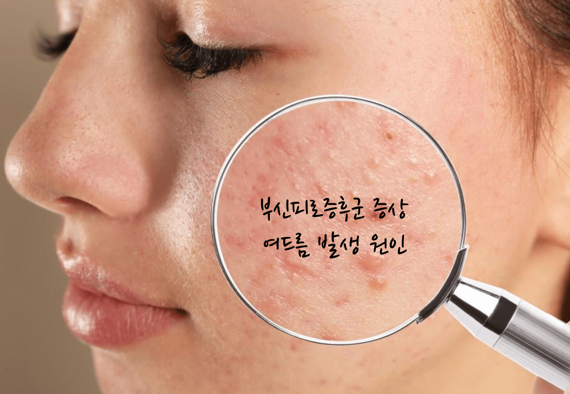 부신피로증후군