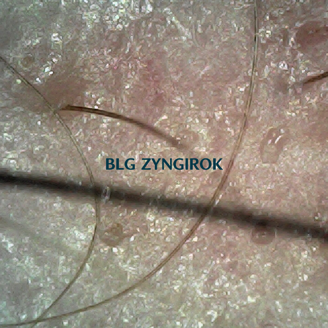 탈모 극복 프로젝트 - 오른쪽 M자 부위 두피 모습이다.