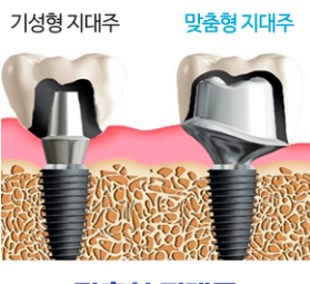 임플란트 건강보험 적용대상